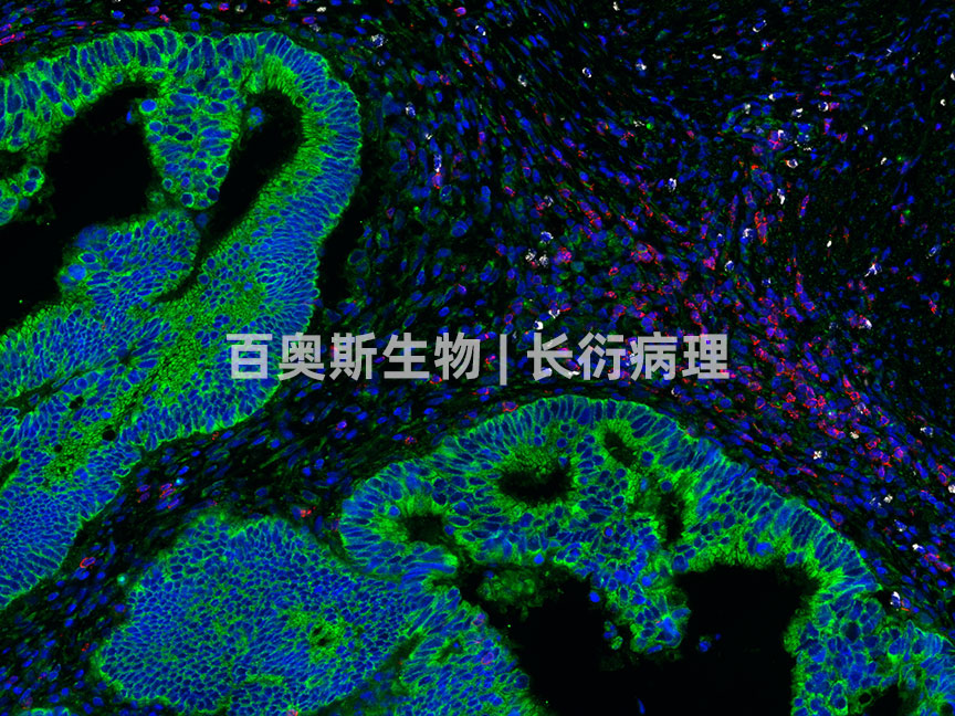 YTHDF2(green)+CD8(red)+c-caspase3(white)---人-肿瘤-200倍---86底板.jpg