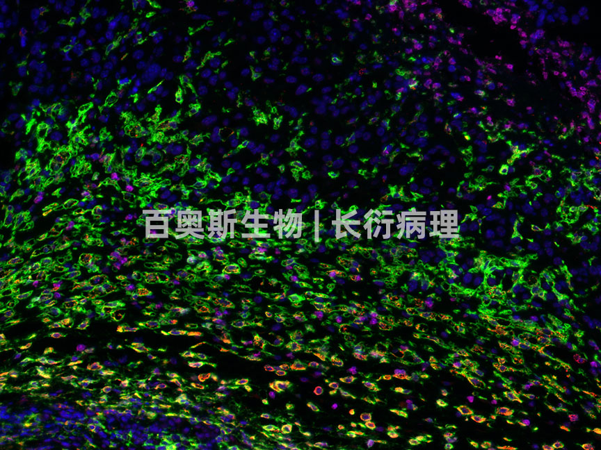 F4-80(green)+CD206(red)+CD11b(pink)---小鼠-肿瘤-200倍---86底板.jpg