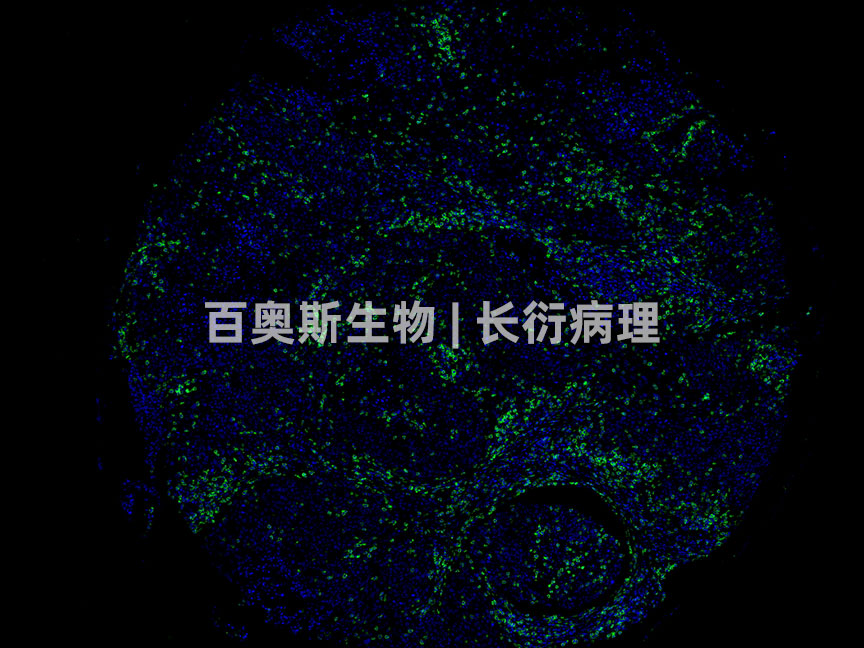 CD8(green)---人-癌组织---86底板.jpg