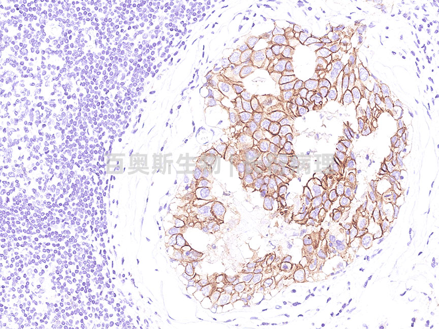 E-Cadherin---人-乳腺癌---86底板.jpg