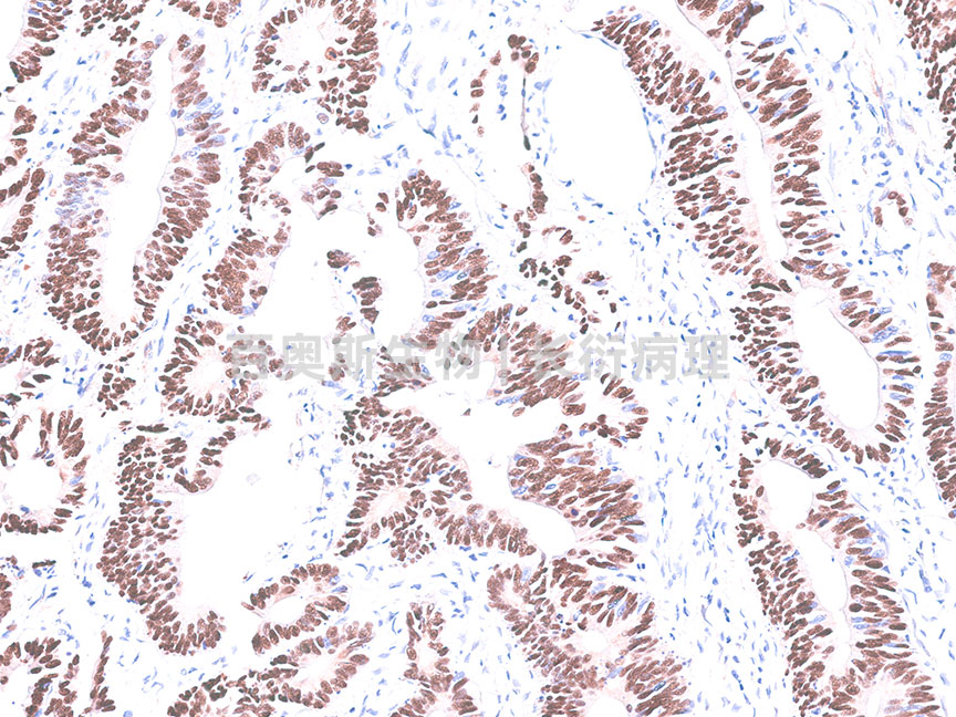 Mutant-P53---人-结直肠癌---86底板.jpg