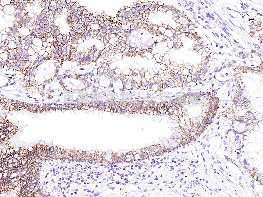 β-catenin---人-肺腺癌---86底板.jpg